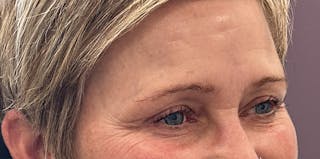 BOTOX Before & After Gallery - Patient 139117 - Image 4