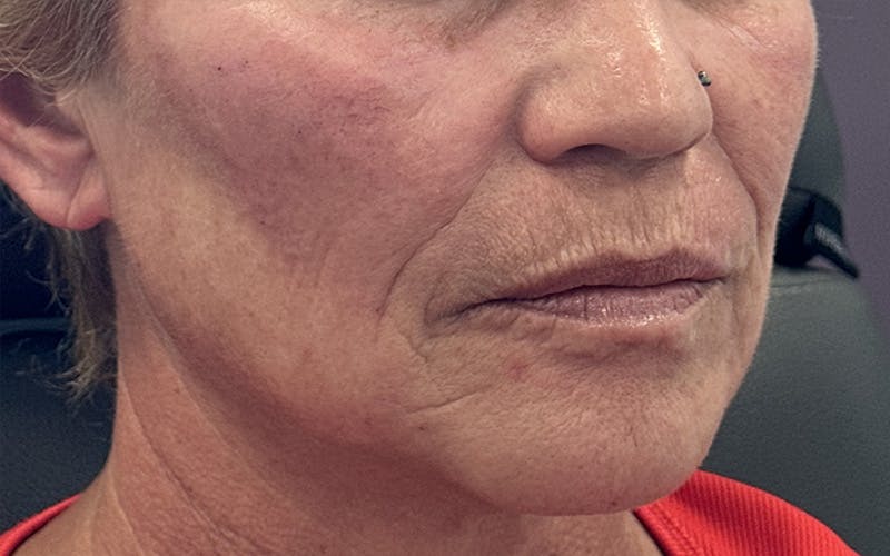 Juvéderm® Before & After Gallery - Patient 301575 - Image 1