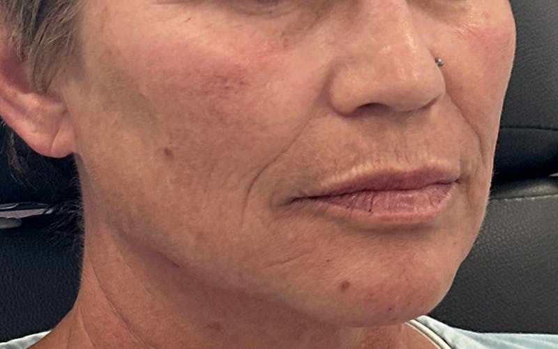 Juvéderm® Before & After Gallery - Patient 301575 - Image 2