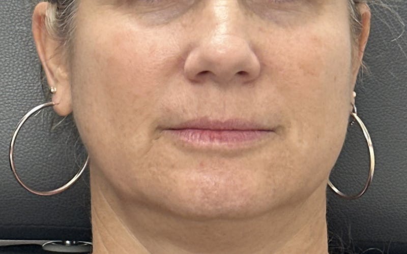 Lip Filler Before & After Gallery - Patient 366343 - Image 1