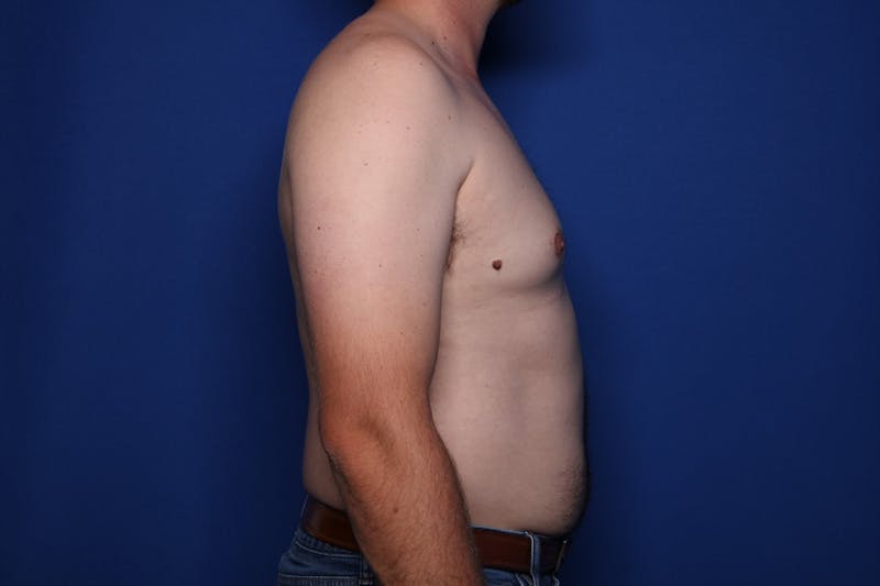 Gynecomastia (Male Breast Reduction) Before & After Gallery - Patient 197171 - Image 5