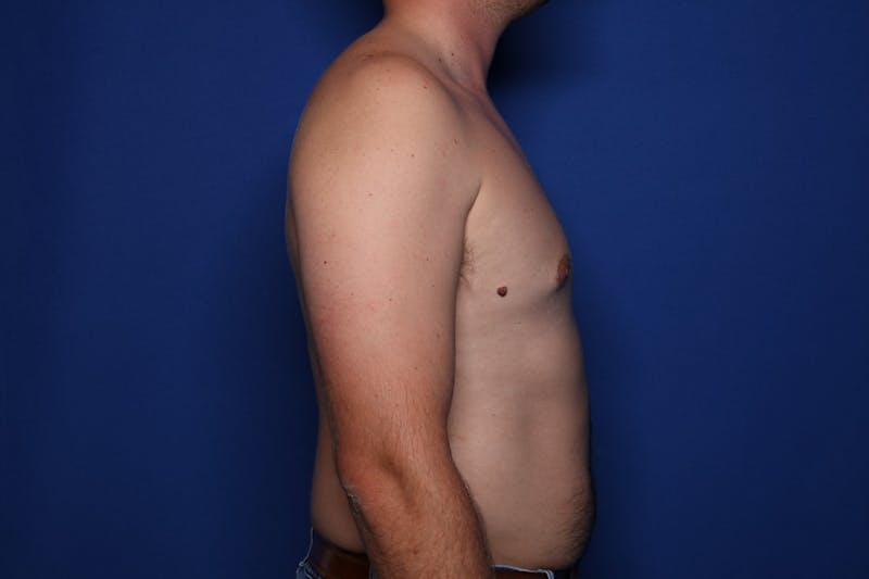 Gynecomastia (Male Breast Reduction) Before & After Gallery - Patient 197171 - Image 6
