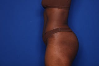 Tummy Tuck Before & After Gallery - Patient 280732 - Image 6