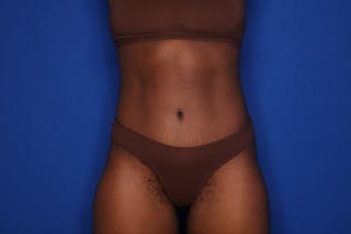 Tummy Tuck Before & After Gallery - Patient 280732 - Image 2
