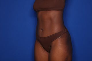 Tummy Tuck Before & After Gallery - Patient 280732 - Image 4