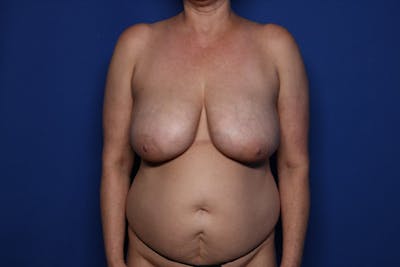 Breast Lift Before & After Gallery - Patient 197841 - Image 1