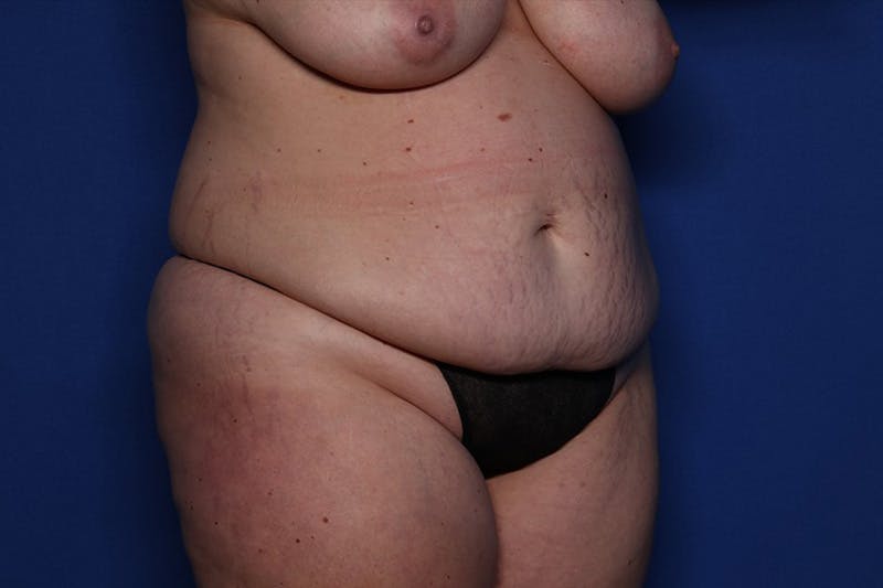 Tummy Tuck Before & After Gallery - Patient 243705 - Image 3