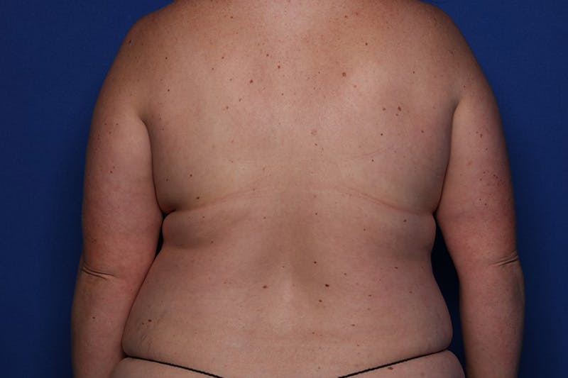 Tummy Tuck Before & After Gallery - Patient 243705 - Image 5