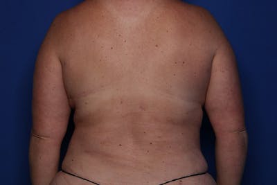 Liposuction Before & After Gallery - Patient 344400 - Image 2