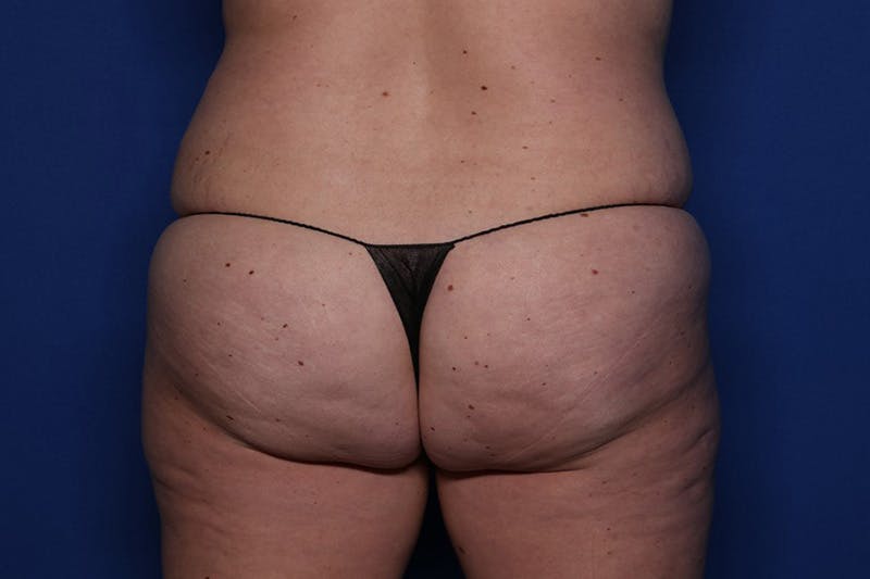 Tummy Tuck Before & After Gallery - Patient 243705 - Image 7
