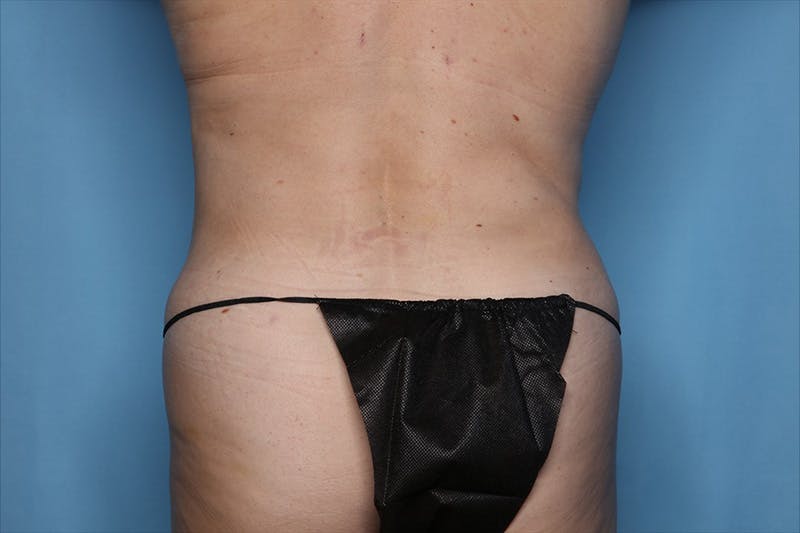 Tummy Tuck Before & After Gallery - Patient 268300 - Image 6