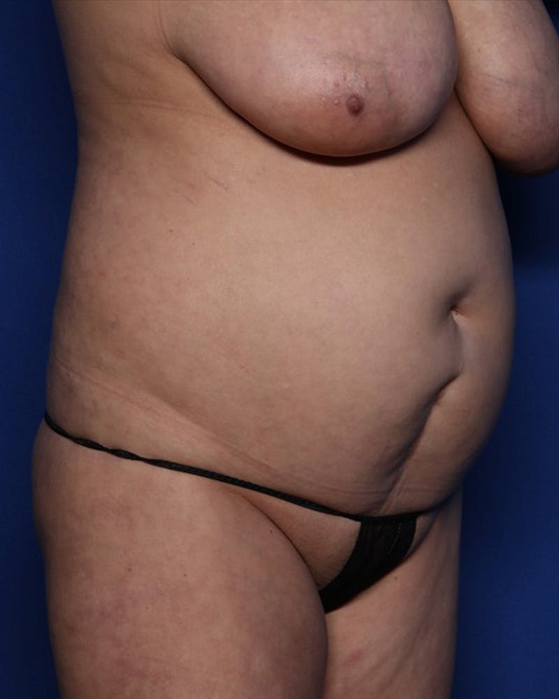 Mommy Makeover Before & After Gallery - Patient 226235 - Image 3