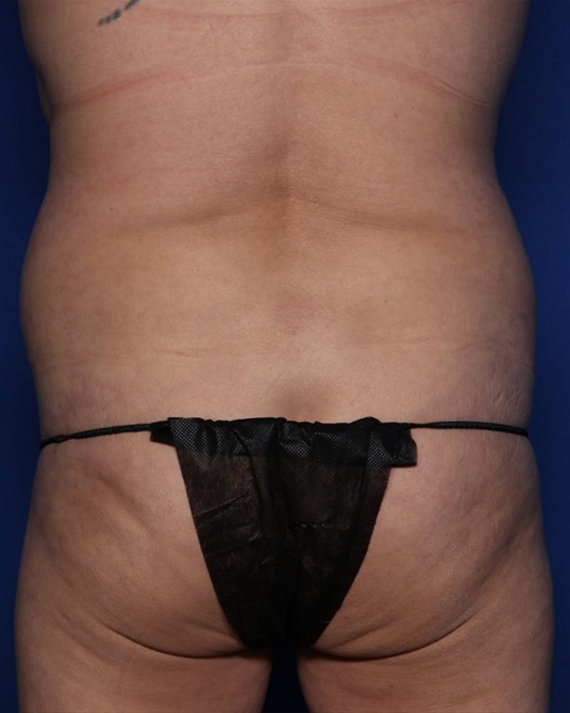 Mommy Makeover Before & After Gallery - Patient 226235 - Image 5