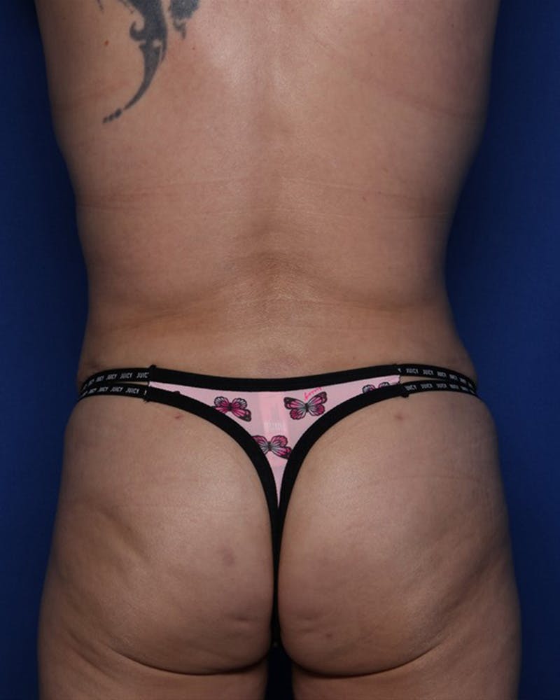 Mommy Makeover Before & After Gallery - Patient 226235 - Image 6