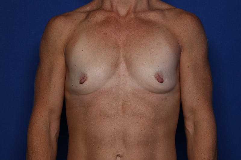 Breast Augmentation Before & After Gallery - Patient 371284 - Image 1