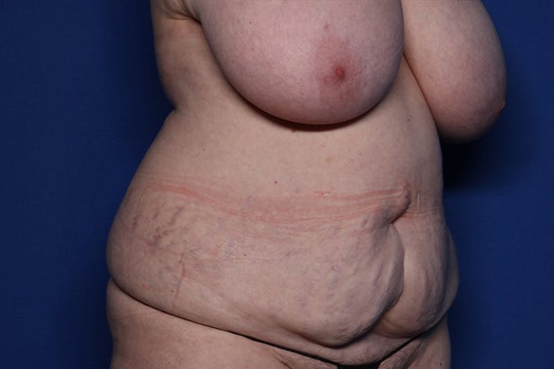 Tummy Tuck Before & After Gallery - Patient 170992 - Image 3