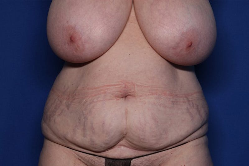 Tummy Tuck Before & After Gallery - Patient 170992 - Image 1