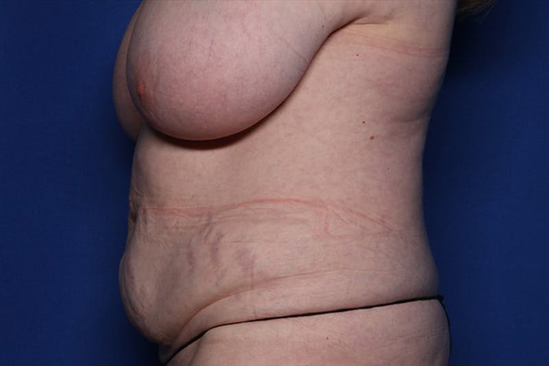 Tummy Tuck Before & After Gallery - Patient 170992 - Image 5