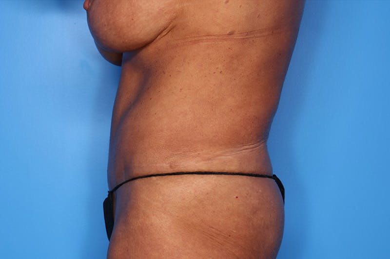 Tummy Tuck Before & After Gallery - Patient 286393 - Image 6