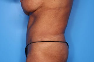 Tummy Tuck Before & After Gallery - Patient 286393 - Image 6
