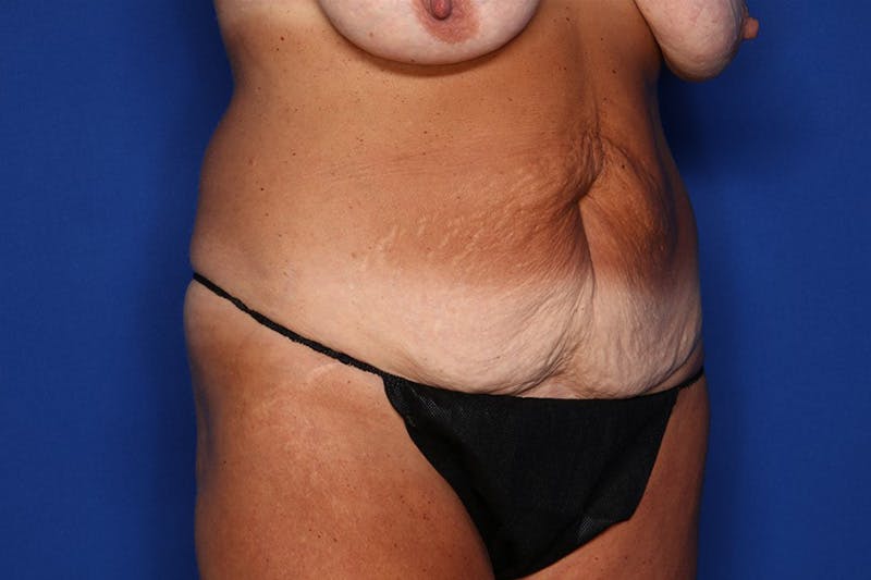 Tummy Tuck Before & After Gallery - Patient 286393 - Image 3