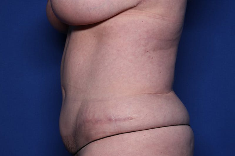 Tummy Tuck Before & After Gallery - Patient 170992 - Image 6