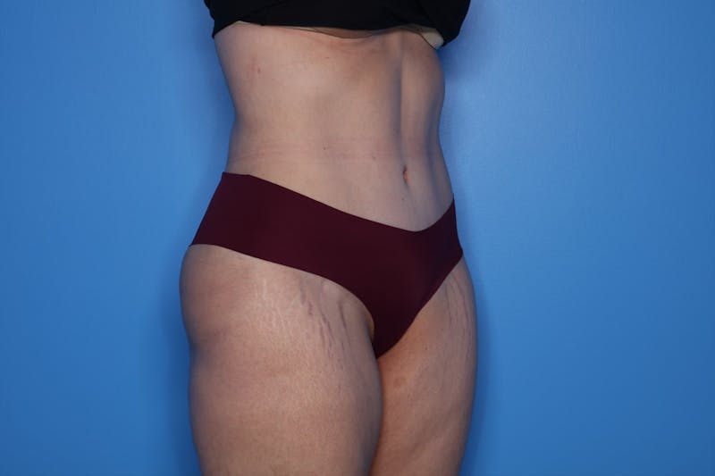 Tummy Tuck Before & After Gallery - Patient 290566 - Image 6