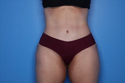 Tummy Tuck Before & After Gallery - Patient 290566 - Image 2