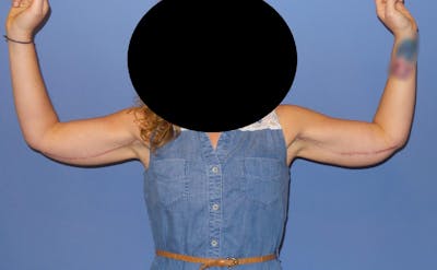 Arm Lift Before & After Gallery - Patient 403840 - Image 2