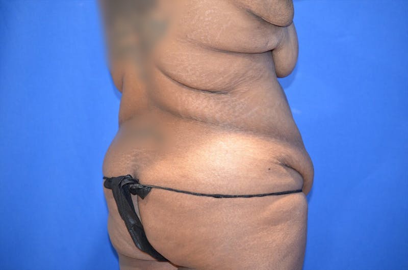 Body Lift Before & After Gallery - Patient 146807 - Image 5