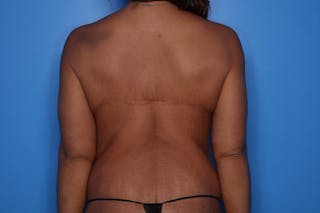 Body Lift Before & After Gallery - Patient 417176 - Image 6