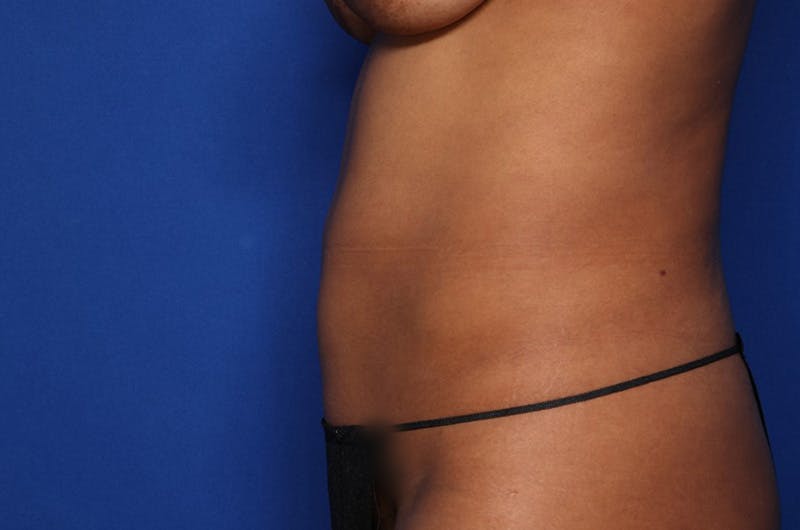 BodyTite™ Before and After Before & After Gallery - Patient 356561 - Image 3