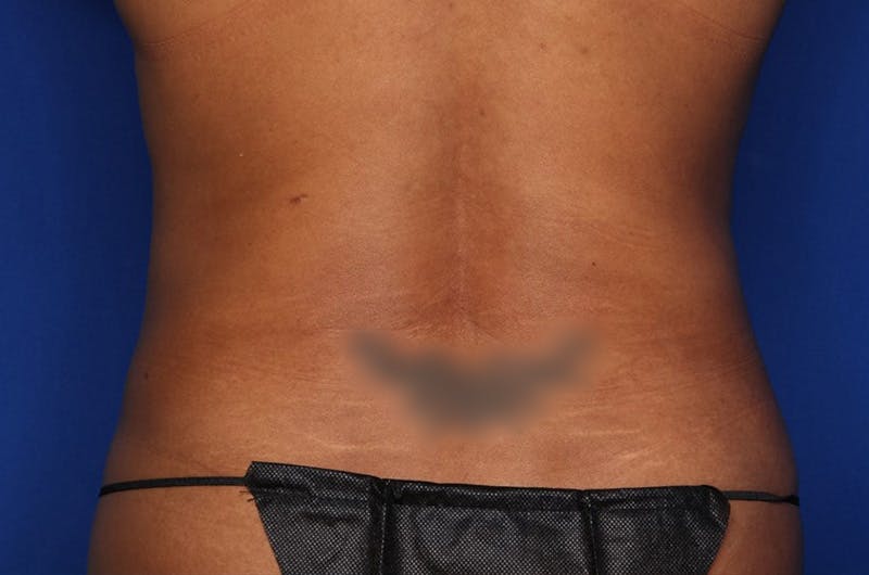 BodyTite™ Before and After Before & After Gallery - Patient 356561 - Image 5