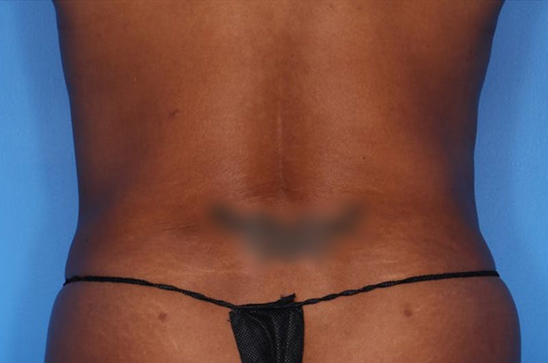 BodyTite™ Before and After Before & After Gallery - Patient 356561 - Image 6