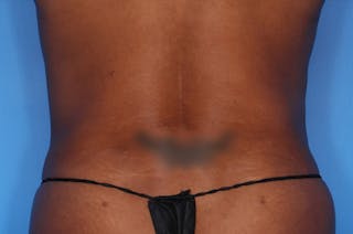 BodyTite™ Before and After Before & After Gallery - Patient 356561 - Image 6