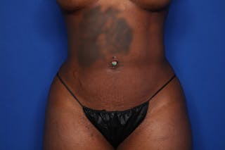 Liposuction Before & After Gallery - Patient 747149 - Image 2