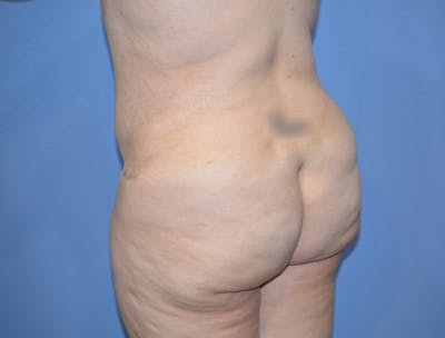 Brazilian Butt Lift Before & After Gallery - Patient 209799 - Image 2