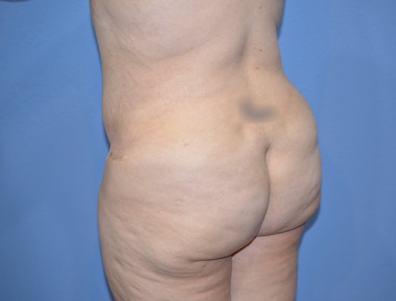 Brazilian Butt Lift Before & After Gallery - Patient 209799 - Image 2