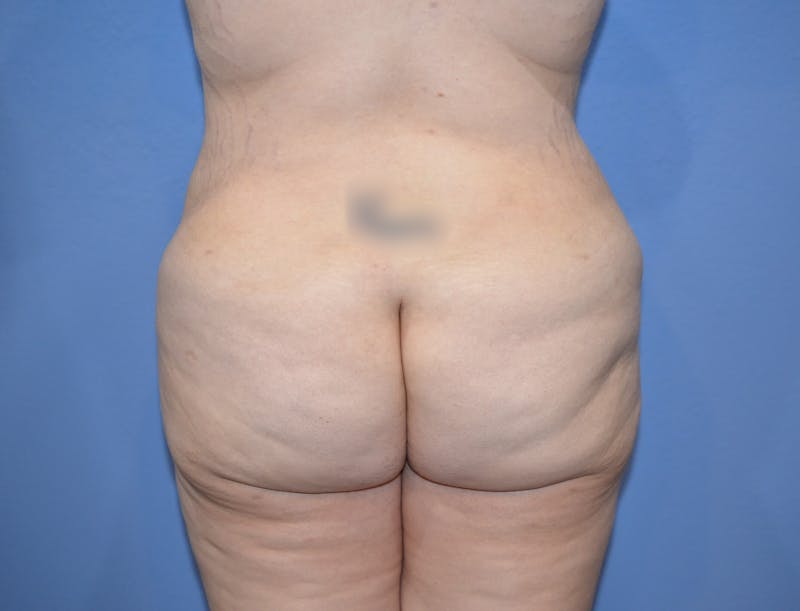 Brazilian Butt Lift Before & After Gallery - Patient 209799 - Image 4