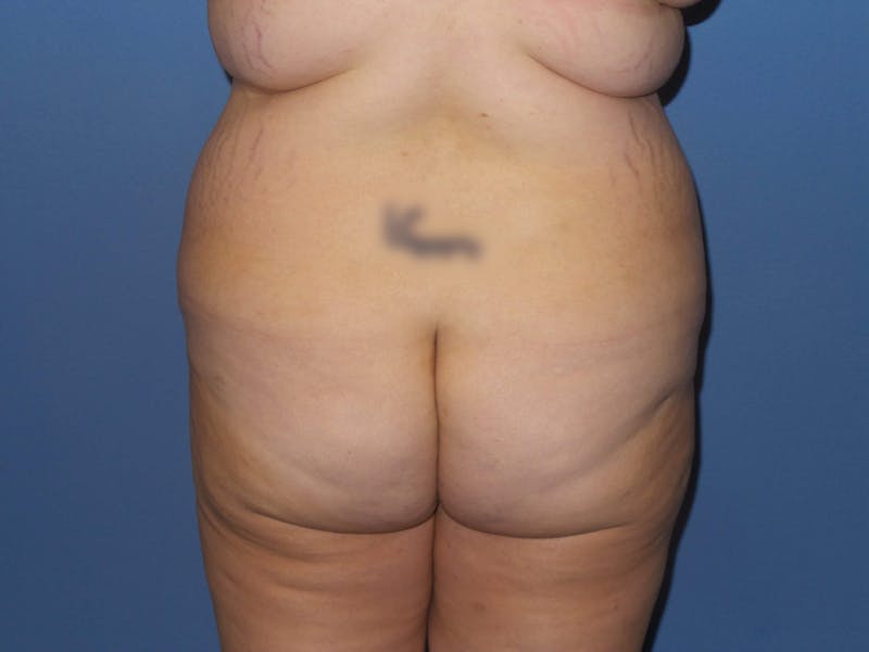 Brazilian Butt Lift Before & After Gallery - Patient 209799 - Image 3