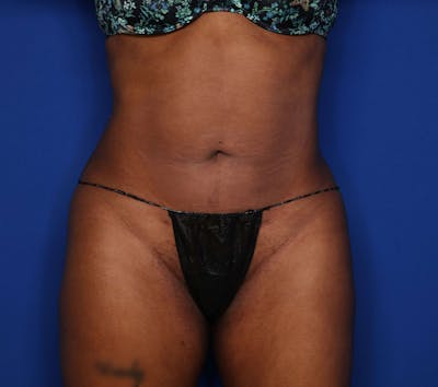 Liposuction Before & After Gallery - Patient 205625 - Image 2