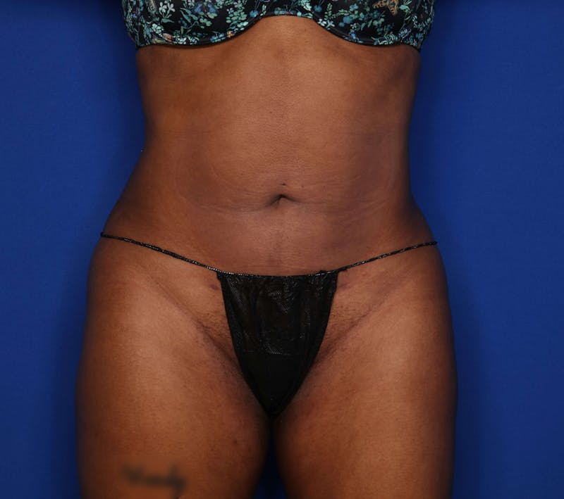 Liposuction Before & After Gallery - Patient 205625 - Image 2