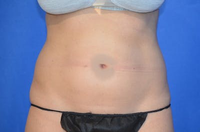 Liposuction Fat Transfer Before & After Gallery - Patient 363478 - Image 1