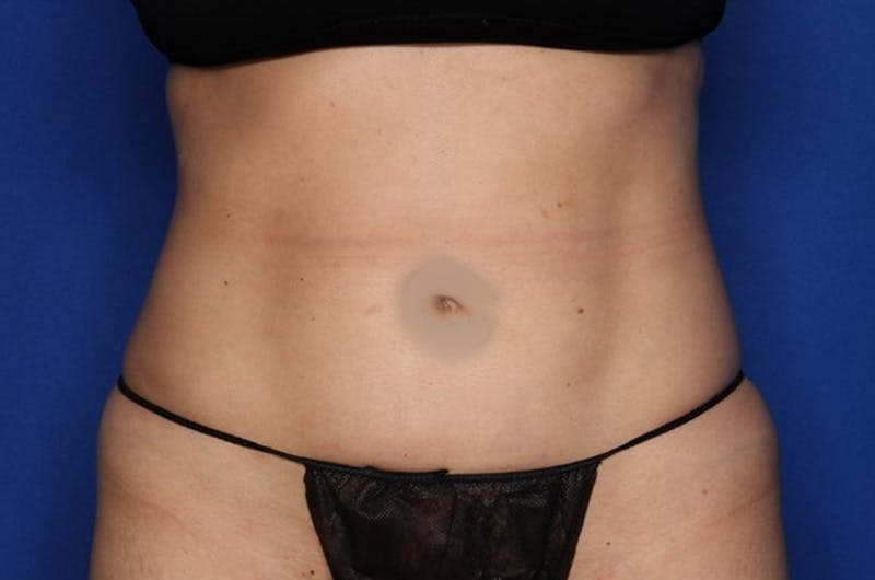 Liposuction Fat Transfer Before & After Gallery - Patient 363478 - Image 2