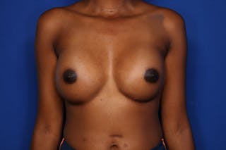 Breast Augmentation Before & After Gallery - Patient 521258 - Image 2