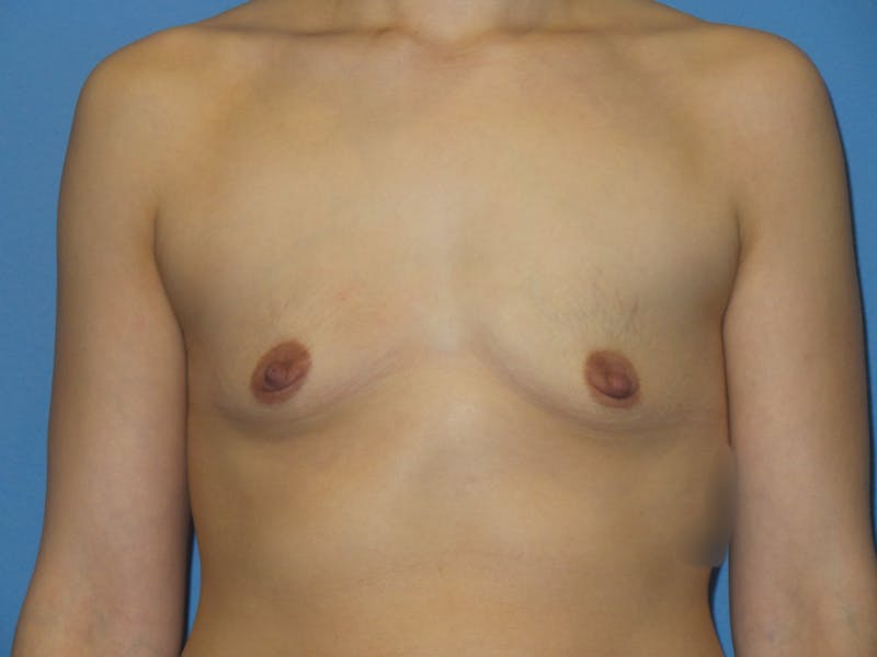 Breast Augmentation Before & After Gallery - Patient 220214 - Image 1