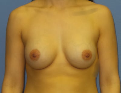 Breast Augmentation Before & After Gallery - Patient 220214 - Image 2