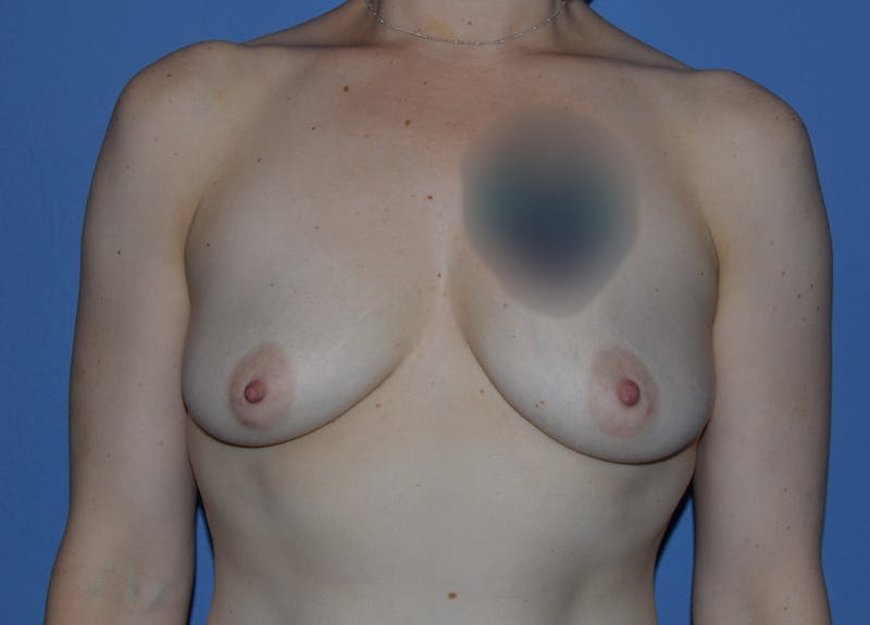 Breast Augmentation Before & After Gallery - Patient 381338 - Image 1