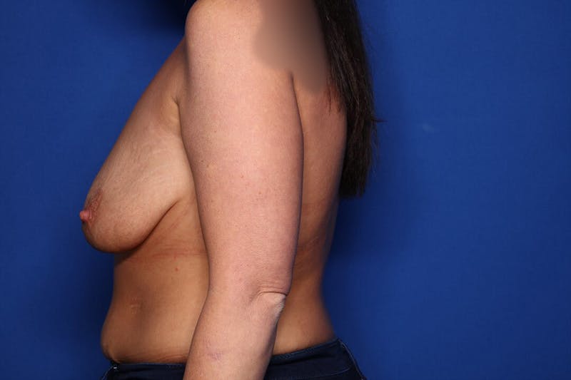 Breast Augmentation + Lift Before & After Gallery - Patient 146732 - Image 5