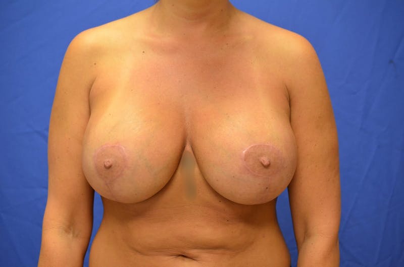 Breast Augmentation + Lift Before & After Gallery - Patient 350777 - Image 2